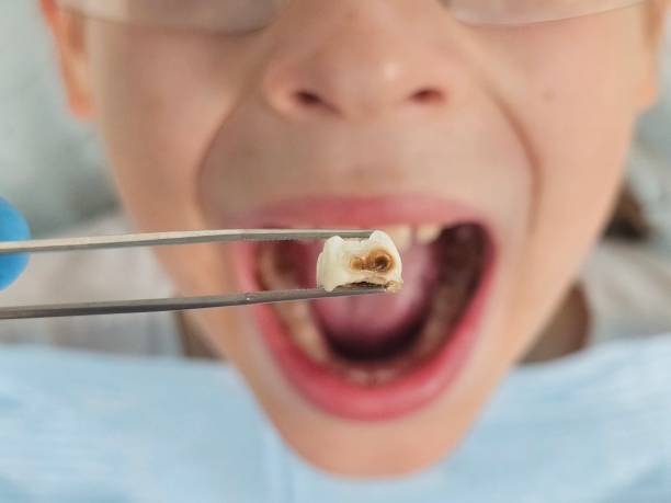Best Emergency Wisdom Teeth Removal in Huntington, UT